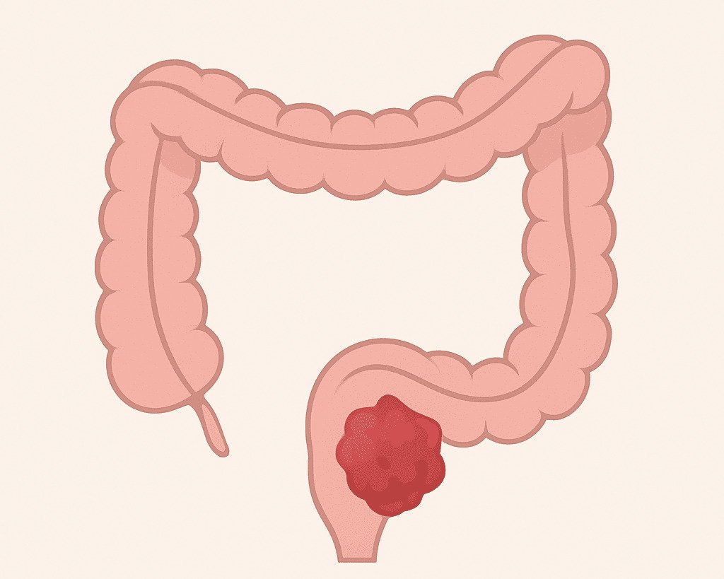 O câncer colorretal, 3º mais comum no Brasil, afeta cólon e reto, desenvolvendo-se de pólipos silenciosos. Clique na imagem para saber mais.