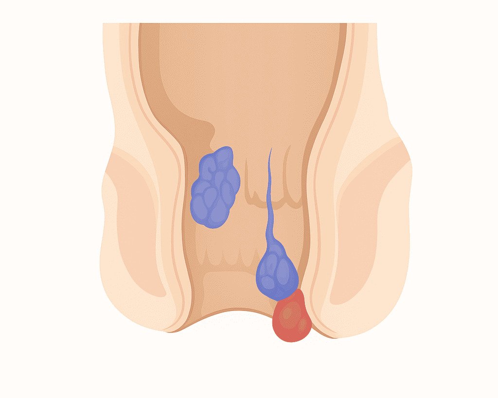 Hemorroidas causam dor, sangramento e prolapso. Comuns, mas constrangedoras, atrasam diagnóstico e tratamento. Clique na imagem para saber mais.